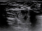 Sonography – Venous malformation on the labium majus