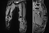 MRI – Combined venolymphatic malformation