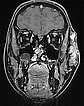 MRI: venous malformation on lateral face