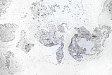 Histopathology Ki67 stain – Intramuscular venous malformation