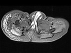 MRI – subcutaneous lymphedema