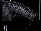 Sonography: before sclerotherapy