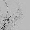 DSA: complete occlusion of the nidus