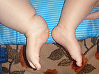 Klippel-Trénaunay syndrome, primary lymphedema