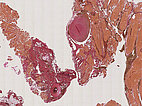 Histopathology EvG stain – Upper airway obstruction