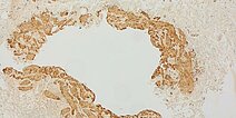 SMA staining – Combined venolymphatic malformation