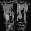 MRI, T1-weighted, fat-saturated