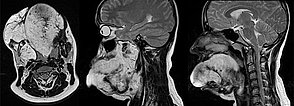 MRI: extensive venous malformation