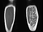 MRI: intramuscular, vascular lesion with marked interstitial hyperintense adipose tissue