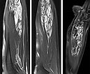 MRI: Venous malformation