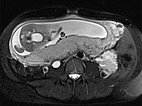 MRI: venous malformation