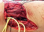 Intraoperative: FAVA in the calf