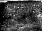 Sonography &ndash; echogenic tissue, interspersed with individual very fine, dilated, fluid-filled lymphatic ducts