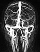 MR angiography: venous malformation