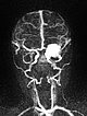 MR angiography: infantile hemangioma on the eyelid