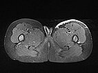 MRI: NICH is still visible under the skin