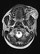 MRI: arteriovenous malformation