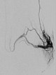 Digital subtraction angiography: Parkes Weber syndrome