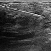 Sonography – Subcutaneous infantile hemangioma