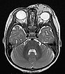 MRI: infantile hemangioma on the eyelid