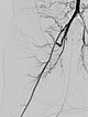 Control angiography – tumor has stopped