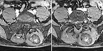 MRI  T1 – Intramuscular venous malformation