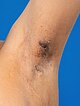 Axilla after bleomycin electrosclerotherapy