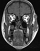 MRI:venous malformation on lateral face