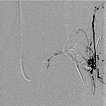 Embolization: Parkes Weber syndrome