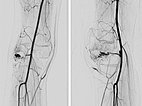 DSA: after embolization with ethylene-vinyl alcohol copolymer