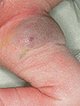 Congenital, blue-livid discolored tumor