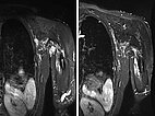 MRI: before and after bleomycin electrosclerotherapy