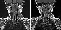 MRI: venous malformation