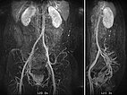 MR angiography  – Intramuscular venous malformation