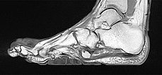 MRI: cerebriform mixed connective tissue nevus