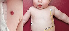 Infantile hemangioma