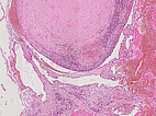 Histopathology H&E staining – Upper airway obstruction