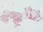 Histopathology H&E stain – Venous malformation on the labium majus