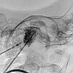 X-ray: embolic agent within the vessels