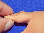 Venous malformation of the thumb