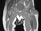 MRI: tumor in the left groin