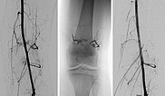 DSA: after embolization