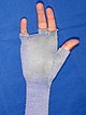 Arteriovenous malformation of the hand