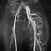 MR-Angiography: Parkes Weber syndrome