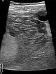 Sonography: venous malformation