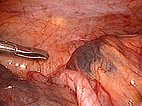 A cyst in front of the cecum