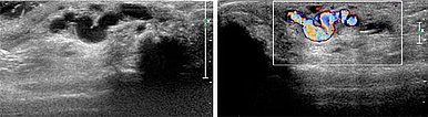 Sonography: subcutaneous dilated drainage vein
