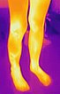 Infrared thermographic photograph: arteriovenous shunts