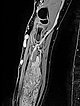 MRI: venous malformation