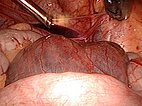 Laparoscopic resection: large retroperitoneal cyst